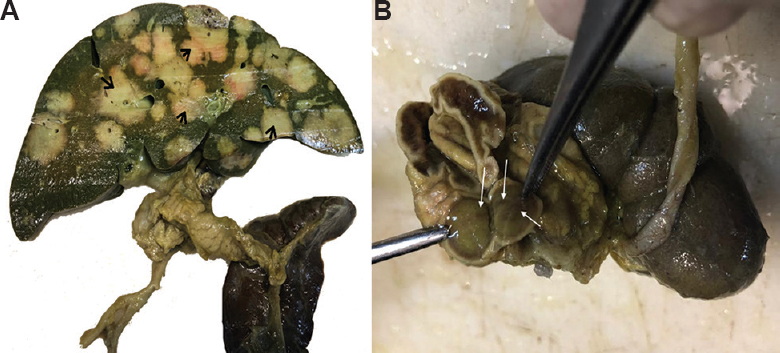 (A) The gross specimen of the liver showing multiple varying sized sub-capsular grey-white lesions with central dark brown areas (arrows) with areas of congestions all over the liver. (B) The gross specimen of the adrenal gland showing similar varying sized grey-white lesions (arrows).